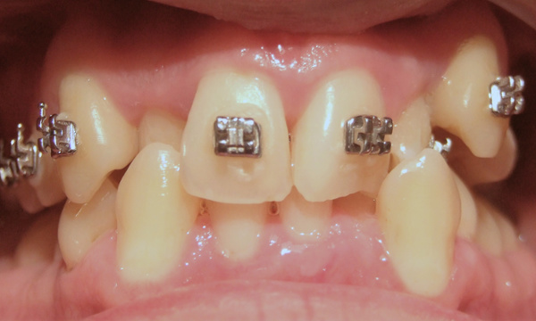 Frontal intraoral view demonstrating severe anterior crowding and an ectopic mandibular canines and maxillary lateral incisors starting adult treatment with traditional metal brackets 