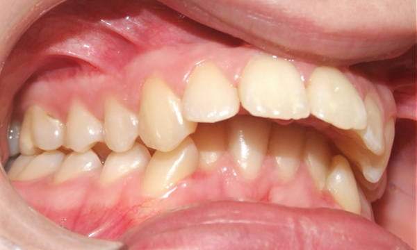 Severe Class II malocclusion intraoral view before orthodontic treatment by Kendall orthodontist.
