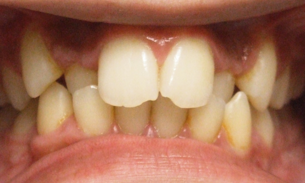 Severe crowding and lateral crossbite before adolescent orthodontic treatment by Kendall orthodontist.