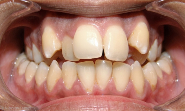 Adult patient with anterior open bite, posterior crossbite, and severe crowding before complex orthodontic treatment at Martinez Orthodontics Miami.