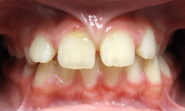 Preteen with posterior crossbite, functional shift, and a thick labial frenum before RPE and braces in Miami.