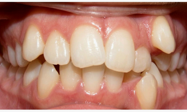 Severe dental crowding and ectopic canine before extraction and metal braces treatment in Miami.