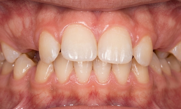 Close-up view of severe dental protrusion before orthodontic treatment with a Herbst appliance in Kendall.