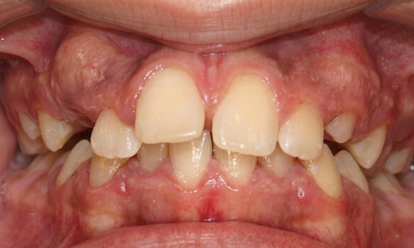 Preteen patient displaying a narrow palate, dental spacing, and protrusion before RPE and braces treatment at Martinez Orthodontics Miami.