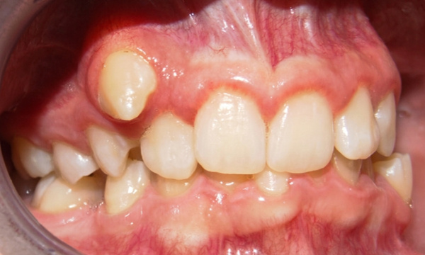 Blocked-out upper canine and severe crowding in transitional dentition before braces in Kendall, Miami.