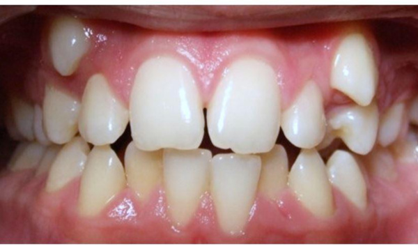 Severe dental crowding and ectopic upper canines before orthodontic extractions and braces in Kendall, Miami.