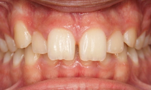 Adolescent patient with a severe deep-bite and elongated front teeth before braces in Miami.