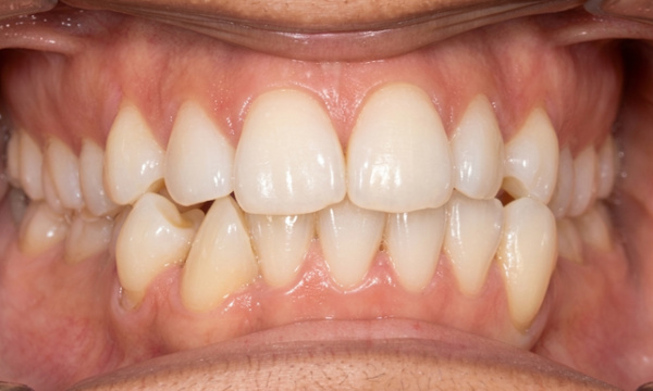 Dental crowding and overlapping teeth before orthodontic treatment at Martinez Orthodontics