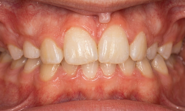 Mixed dentition with mild crowding and moderate overbite before braces in Miami.