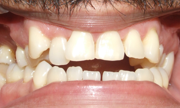 Adult patient with a collapsed occlusion, anterior open bite, and mutilated dentition prior to multidisciplinary braces treatment at Martinez Orthodontics in Miami.