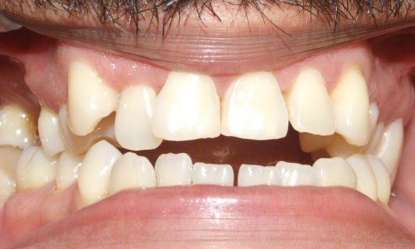 Adult patient with a collapsed occlusion, anterior open bite, and mutilated dentition prior to multidisciplinary braces treatment in Miami.