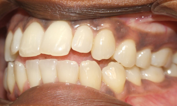 Clinical close-up of an adult female with a pronounced anterior open bite before orthodontic treatment.