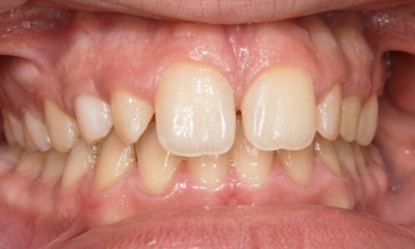 Narrow upper jaw and dental crowding in a pre-teen patient before palatal expansion in Kendall, Miami.