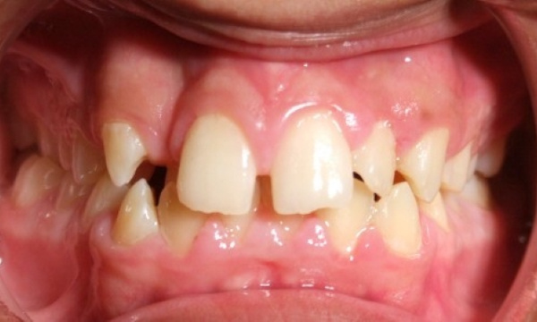 Severe dental crowding, narrow palate, and crossbite before palatal expansion and metal braces treatment in Miami.