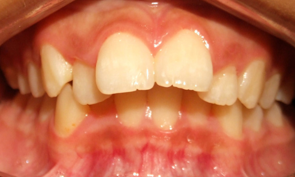 Preteen patient with severe overjet protrusion and moderate crowding before traditional metal braces treatment in Miami.