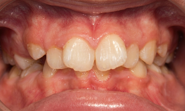 Preteen patient displaying a narrow palate and severe dental crowding before RPE and braces treatment at Martinez Orthodontics Miami.