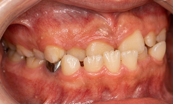 Preteen patient in mixed dentition with an anterior crossbite underbite before Phase I orthodontic treatment in Miami.