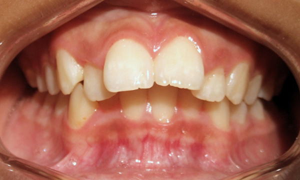 Preteen patient with severe overjet protrusion and moderate crowding before traditional metal braces treatment in Miami.