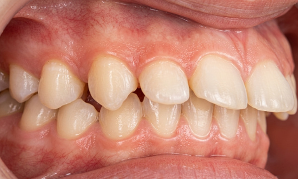 Protruding upper teeth and dental spacing caused by thumb-sucking habits before orthodontic treatment in Miami