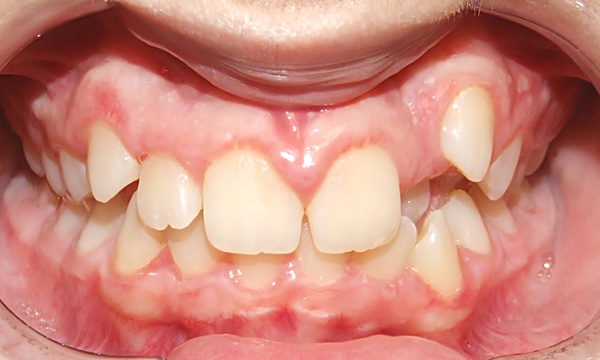 Teen patient displaying severe dental crowding before traditional braces treatment at Martinez Orthodontics Miami.