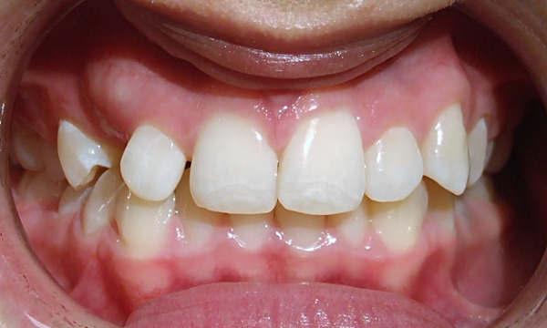 Teenager with Class I malocclusion and impacted canine #6 before braces and subsequent surgical exposure in Miami.