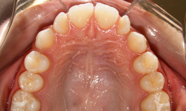 Upper dental arch photo showing noticeable gaps between the upper teeth due to small lateral incisors prior to treatment.