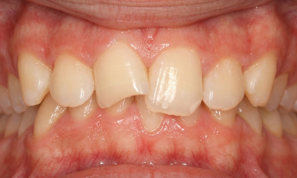 Teenage patient with a recessed lower jaw, severe overjet, and a fractured front tooth before metal braces and Herbst appliance treatment in Miami.