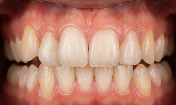 Teenage patient with posterior open bite and misplaced lower canine before traditional metal braces treatment in Miami.