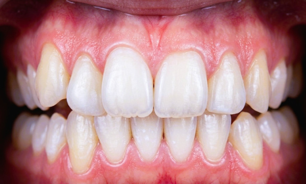 Teenage patient with posterior open bite and misplaced lower canine before traditional metal braces treatment in Miami.