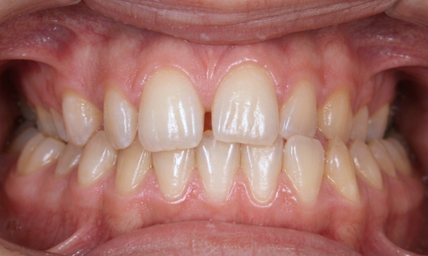 Adolescent patient with a Class III malocclusion, narrow maxilla, and functional shift before RPE and braces at Martinez Orthodontics in Miami.