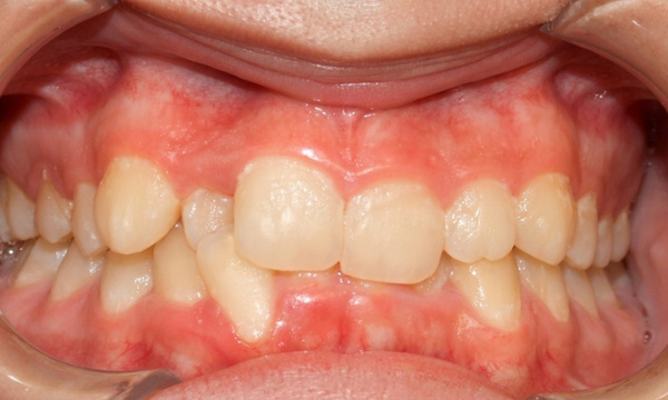 Close-up of a student's smile showing severe dental crowding prior to braces.