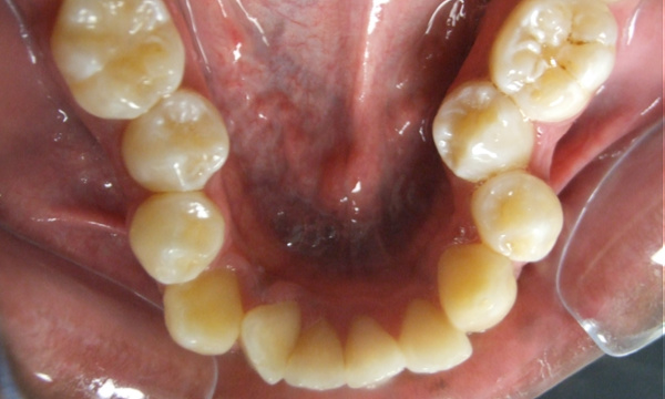 Severe lower dental crowding and collapsed arch in an adult patient before orthodontic treatment at Martinez Orthodontics Miami.