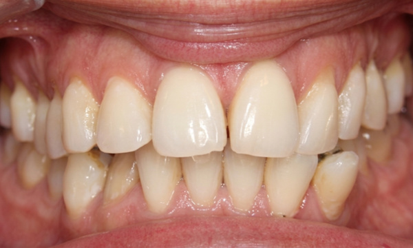 Close view of teeth pushed out of alignment by a loose retainer wire before orthodontic care.