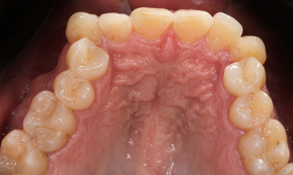 Intraoral occlusal view of a narrow, square-shaped maxillary arch in an adult patient before RPE treatment at Martinez Orthodontics Miami.