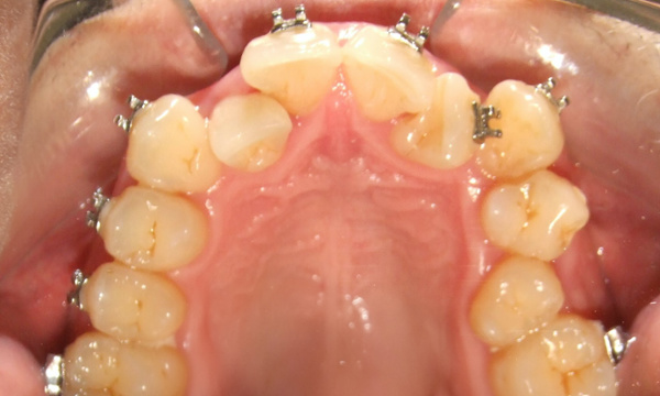 Intraoral occlusal view of a maxillary arch with severe anterior crowding, showing traditional orthodontic brackets bonded to some teeth.