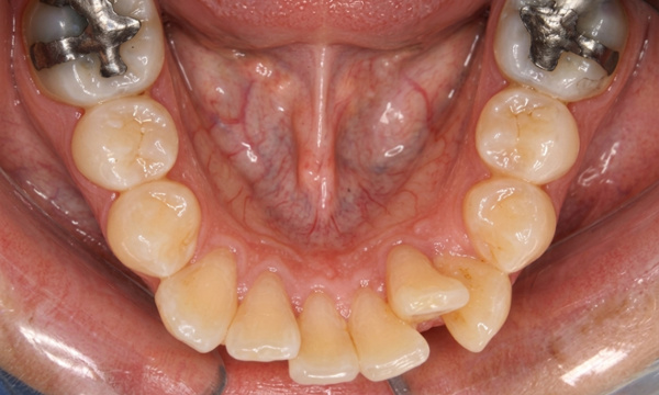 Lower teeth crowding: Kendall orthodontist before-and-after case.