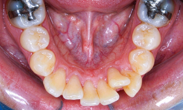 Lower teeth crowding: Kendall orthodontist before-and-after case.
