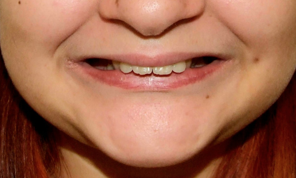 Patient portrait before severe Class II malocclusion treatment by Kendall orthodontist.