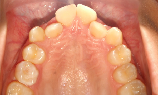 Narrow palate and ectopic lateral incisors before Rapid Palatal Expander treatment in Kendall.