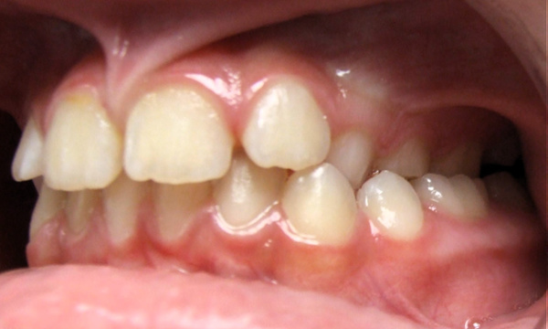 Intraoral side view of a posterior crossbite and misaligned dental arches before RPE treatment in Miami.