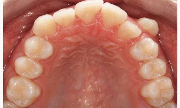 Intraoral view of severe dental crowding and ectopic canines before traditional metal braces treatment in Miami