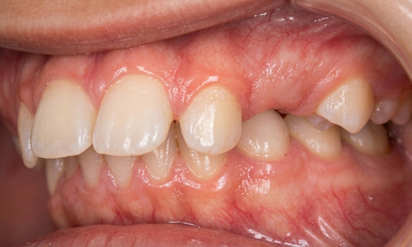 Lateral intraoral view showing severe dental protrusion and Class II malocclusion before orthodontic treatment in Kendall.