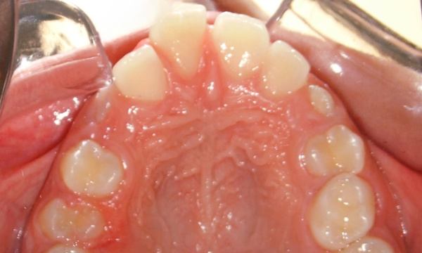 Occlusal view of a narrow maxilla with dental spacing and protrusion in a preteen before RPE treatment at Martinez Orthodontics Miami.