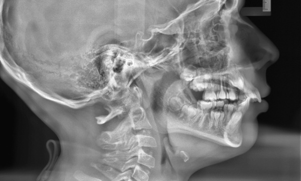Cephalometric radiograph of a preteen showing a retrognathic jaw and skeletal Class II relationship before Herbst treatment in Miami.