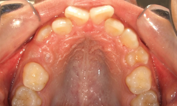 Occlusal view of a narrow maxilla and severe dental crowding in a preteen before RPE treatment at Martinez Orthodontics Miami.