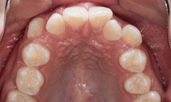 Initial clinical view of significant dental crowding and narrow arch width prior to specialist orthodontic treatment at Martinez Orthodontics Miami.