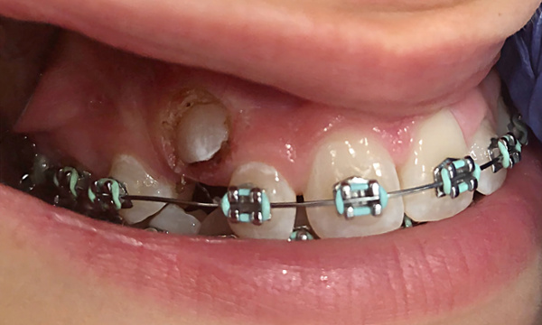 Intraoral view of the surgical exposure of impacted canine #6 via electrocauterization in Miami.