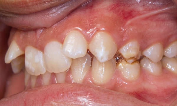 Close up view of a teen deep bite and angled upper teeth before traditional braces in Miami.