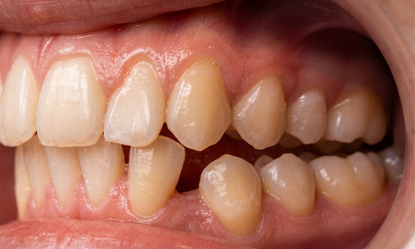 Intraoral side view of a lingually ectopic lower canine and posterior open bite before traditional metal braces in Miami