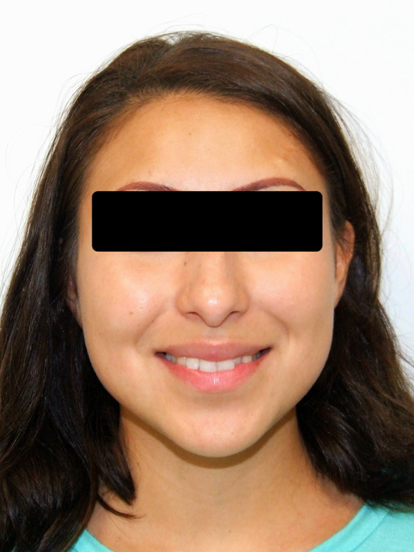 Adult smile before braces: Miami orthodontist patient portrait.